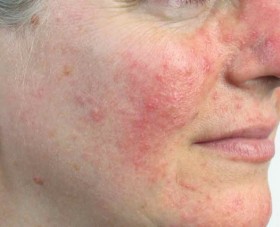 www.puurlindainstituut.nl rosacea