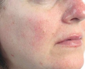 www.puurlindainstituut.nl rosacea